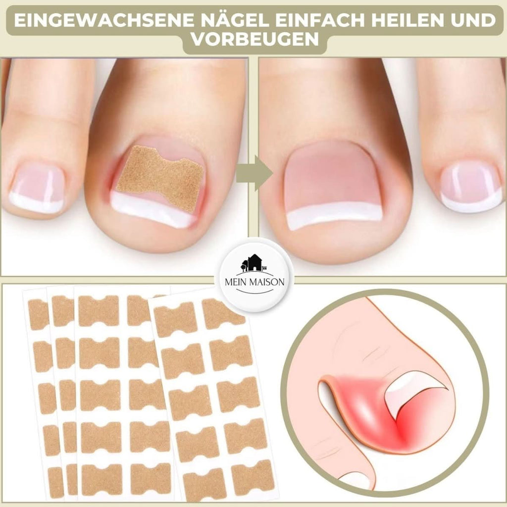NailRelief Ingrown Nail Correction Tool, Painless Gentle Lift For Home Use