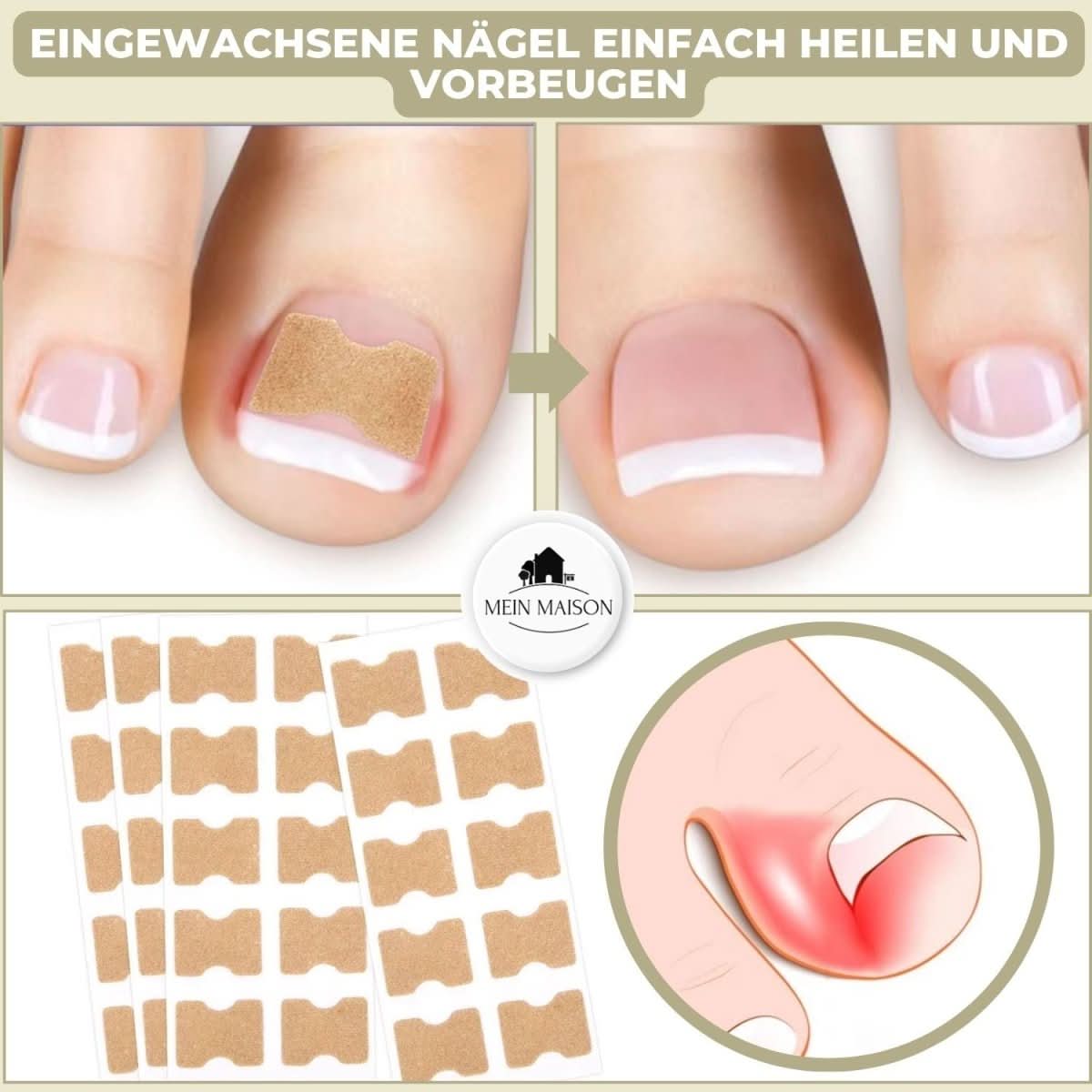 NailRelief Ingrown Nail Correction Tool, Painless Gentle Lift For Home Use