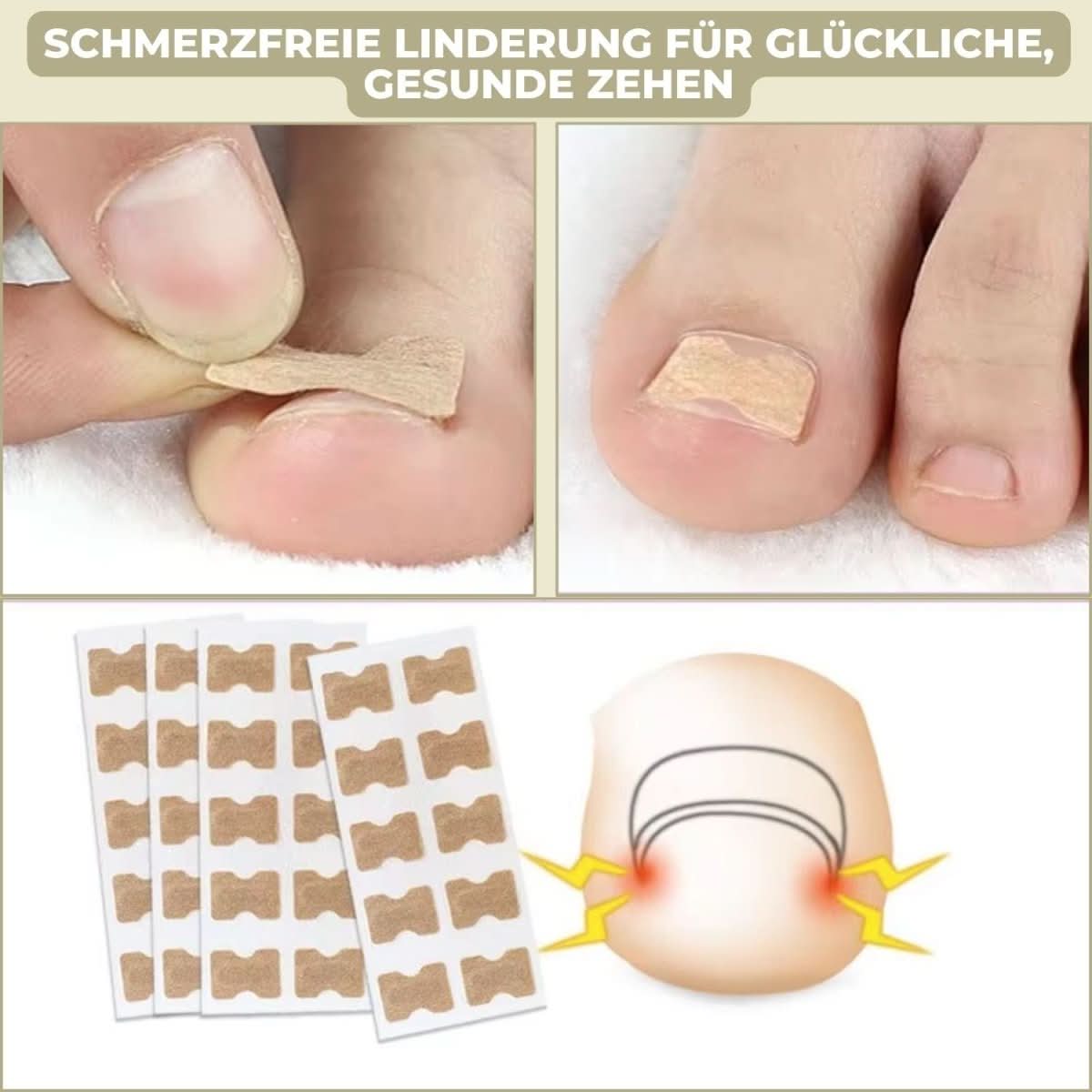 NailRelief Ingrown Nail Correction Tool, Painless Gentle Lift For Home Use