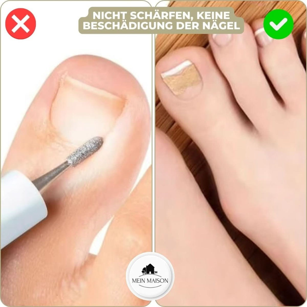 NailRelief Ingrown Nail Correction Tool, Painless Gentle Lift For Home Use