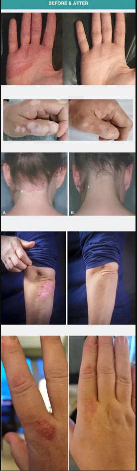 308nm UVB Phototherapy Light for Face, Neck & Limbs with 3 Interchangeable Lampshades