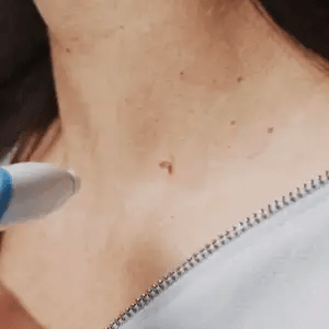 Auto tag removal kit - remove skin tags