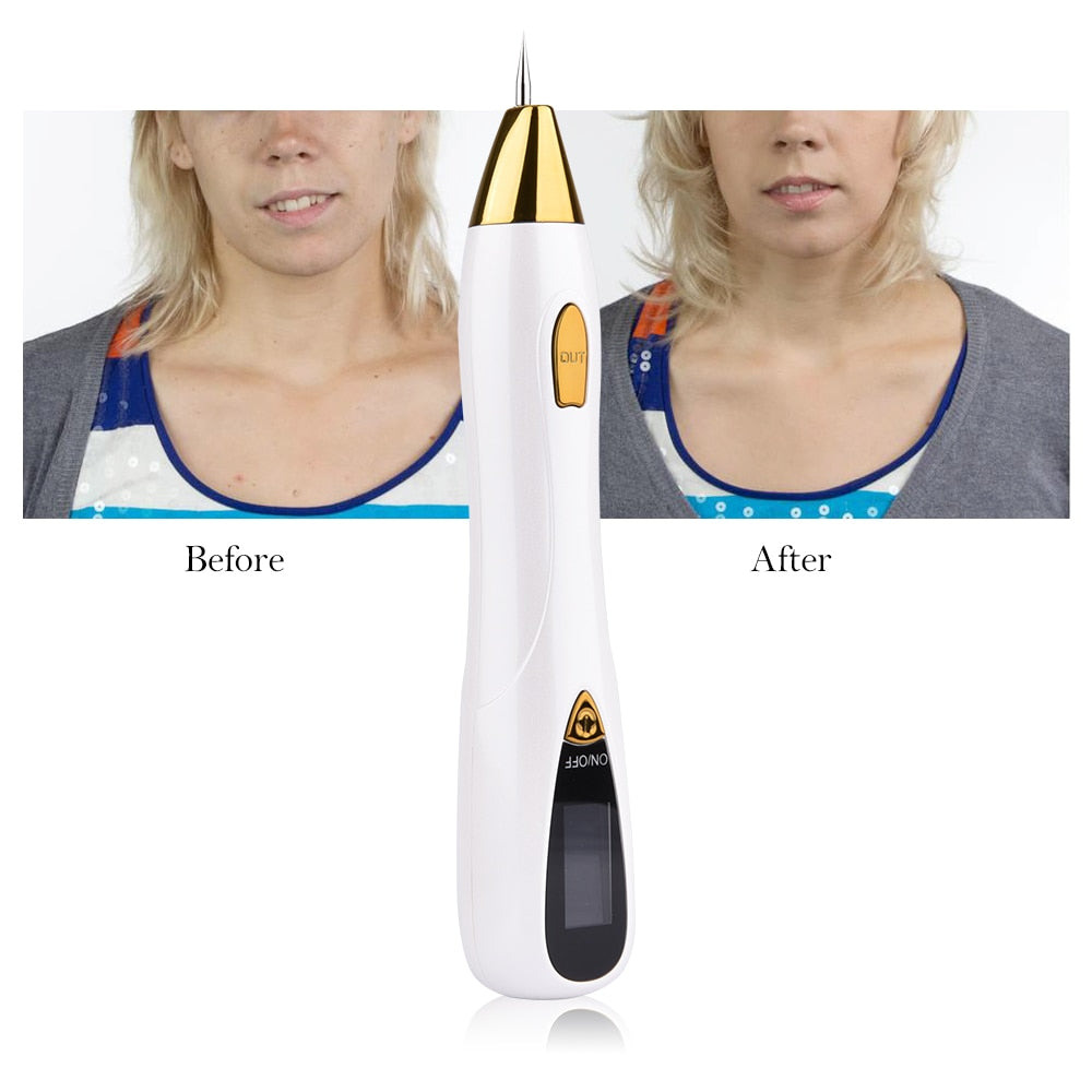 LuminaDerm Muttermalentfernungsstift Pro Edition für präzise Muttermalpflege