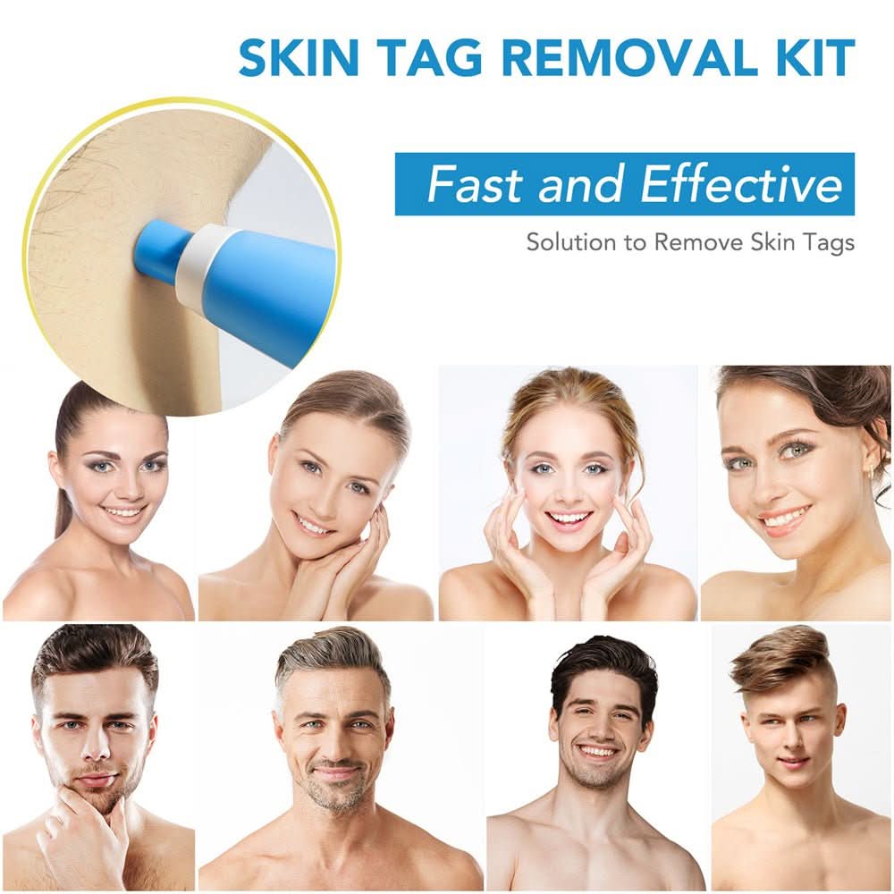 מסיר יבלות עור TagAway לשימוש ביתי ללא כאבים לצוואר, גב וגוף