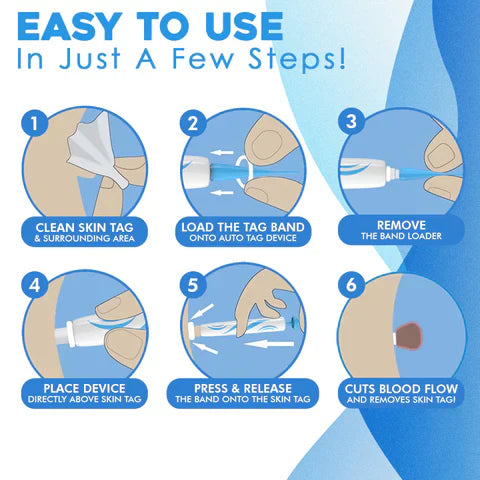 Auto tag removal kit - remove skin tags