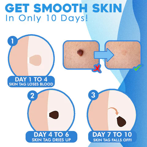 Auto tag removal kit - remove skin tags