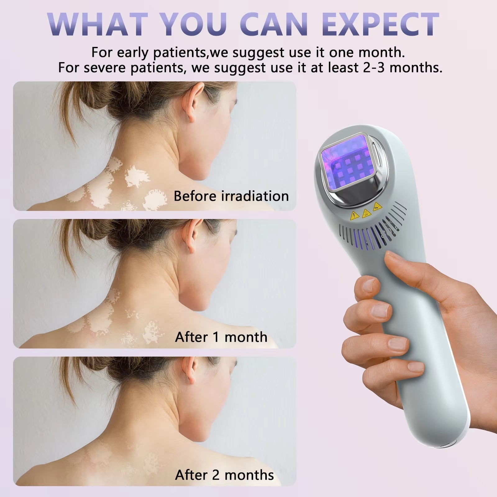 308nm UVB Phototherapy Light for Face, Neck & Limbs with 3 Interchangeable Lampshades