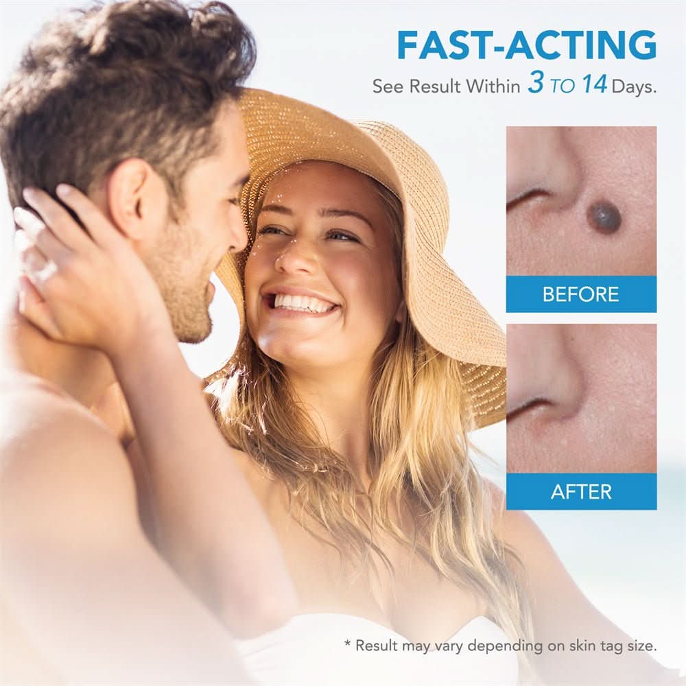 EPICLEAR Home Skin Tag and Wart Removal Kit for Easy Care