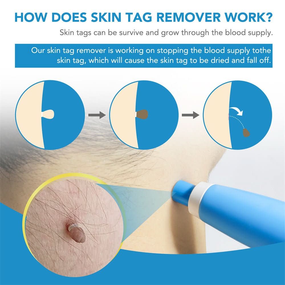 EPICLEAR Home Skin Tag and Wart Removal Kit for Easy Care
