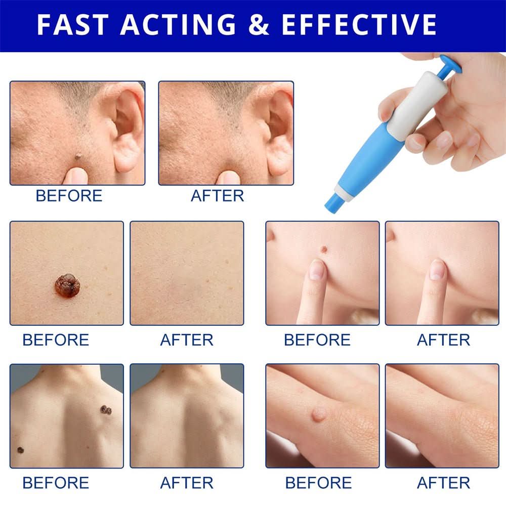 EPICLEAR Home Skin Tag and Wart Removal Kit for Easy Care