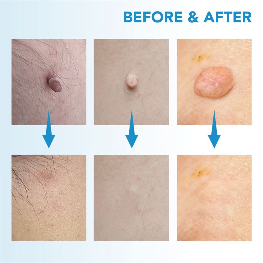 EPICLEAR Home Skin Tag and Wart Removal Kit for Easy Care
