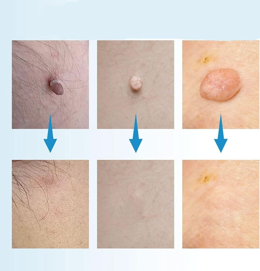 EPICLEAR Home Skin Tag and Wart Removal Kit for Easy Care