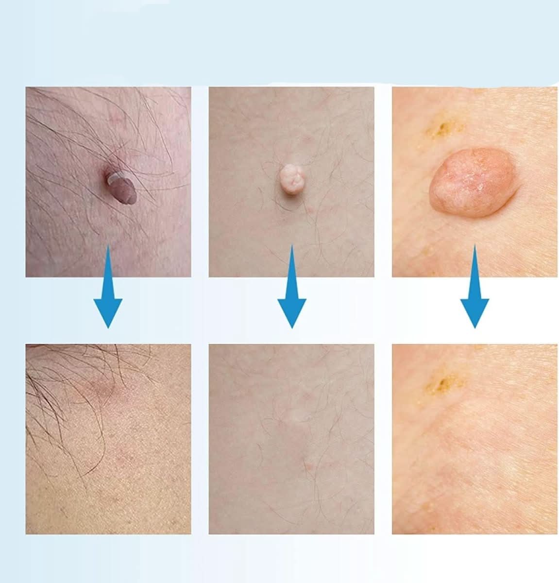 EPICLEAR Home Skin Tag and Wart Removal Kit for Easy Care