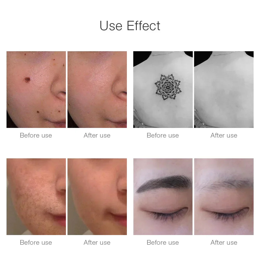 AstraDerm Picosecond Laser Remover for Tattoos and Spots